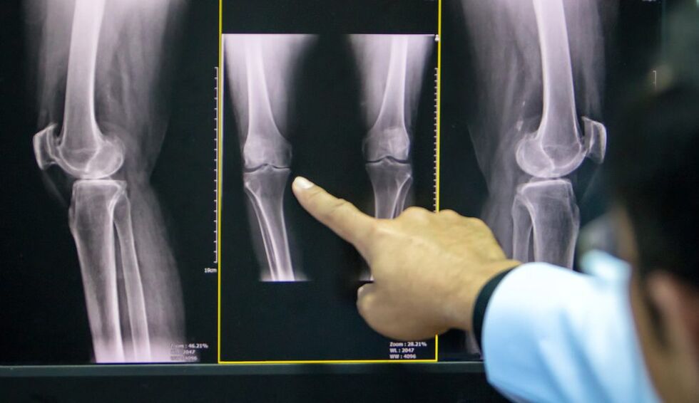 arthrosis na gwiwa x-ray