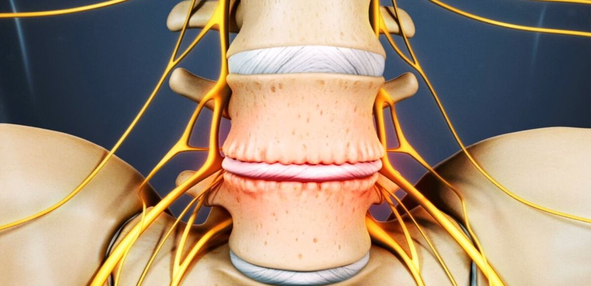 Osteochondrosis na kashin baya na lumbar