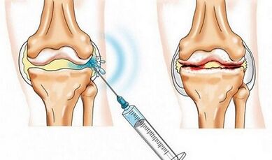 Kabe na gwiwa hadin gwiwa ga Arthrosis