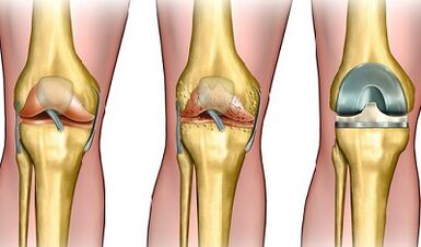 Mataki na ci gaban arthrosis na gwiwa hadin gwiwa