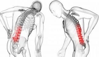 Hernia na Intervertemral Hernia - rikicewa tare da osteochondrosis