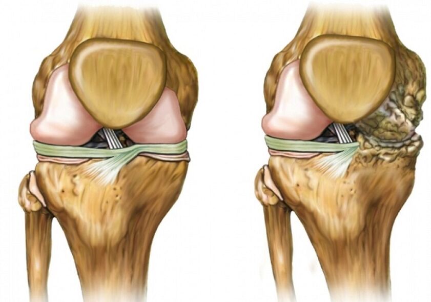 Arthrosis na gwiwa