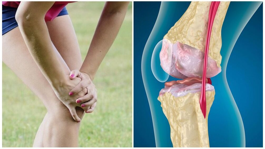 Bayyanar cututtuka na arthrosis