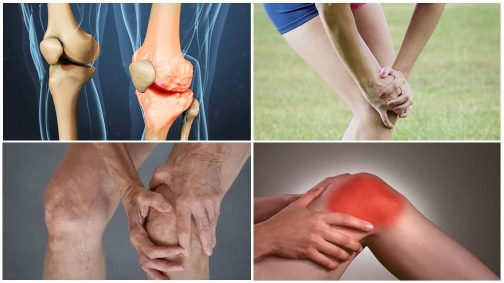 Matakan Arthrosis