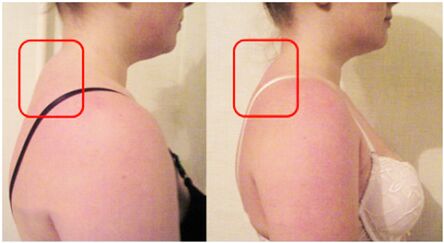 Samuwar tsoka tare da ervical osteochondrosis