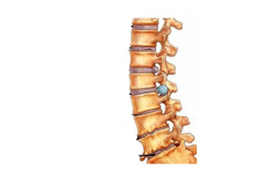 Lalacewa a kashin baya tare da ervical osteochondrosis