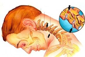 Pinching na jijiya a cikin kashin baya tare da ervical osteochondrosis