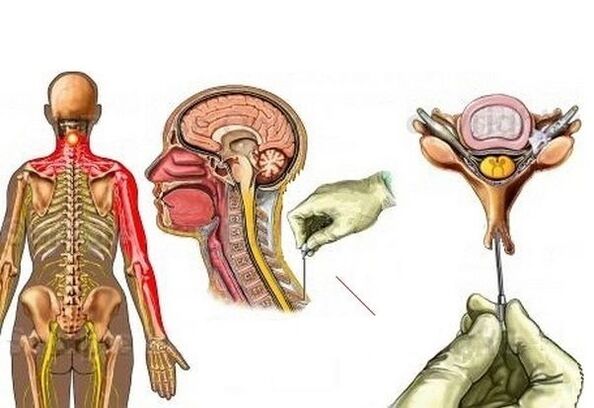 lura da osteochondrosis tare da acupuncture