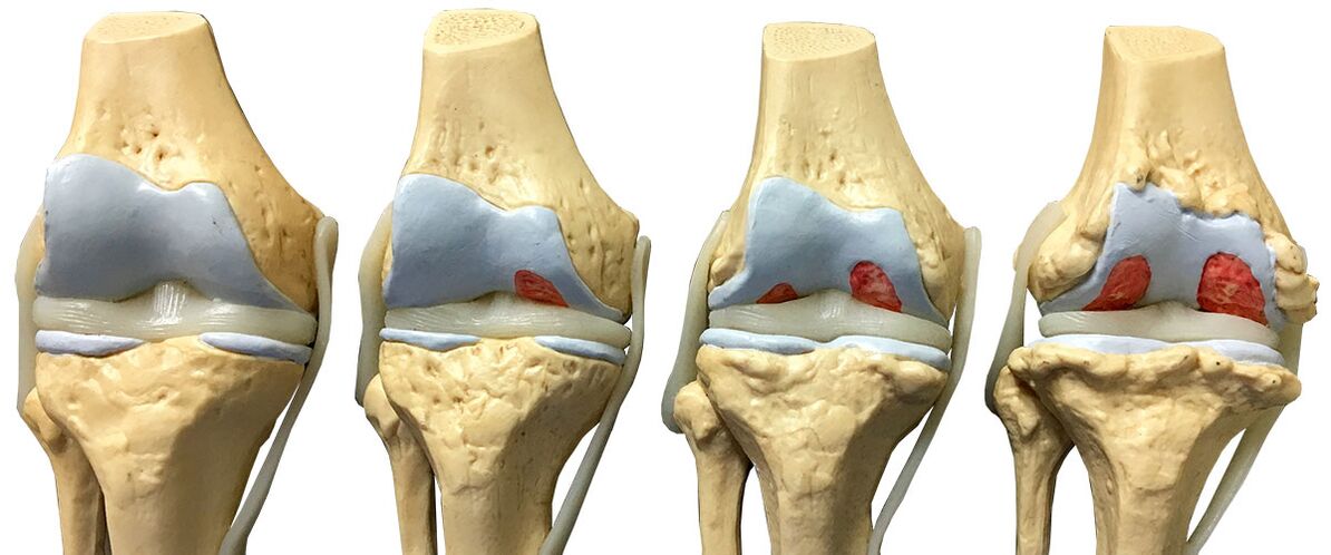 matakai na arthrosis