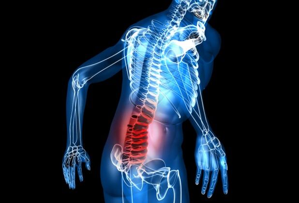Menene lumbar osteochondrosis