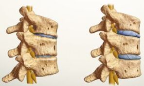 Menene osteochondrosis yayi kama