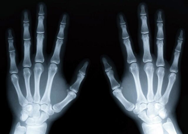 Gout yana haifar da ci gaban gouty arthritis, wanda za'a iya gano shi ta amfani da hasken x-ray