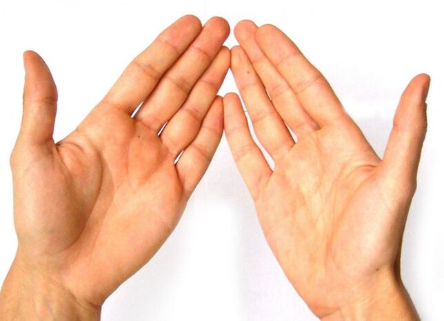 Rheumatoid amosanin gabbai yana shafar haɗin gwiwar yatsunsu saboda rashin aiki na tsarin rigakafi