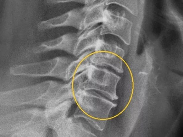 Osteochondrosis na kashin mahaifa a kan x-ray